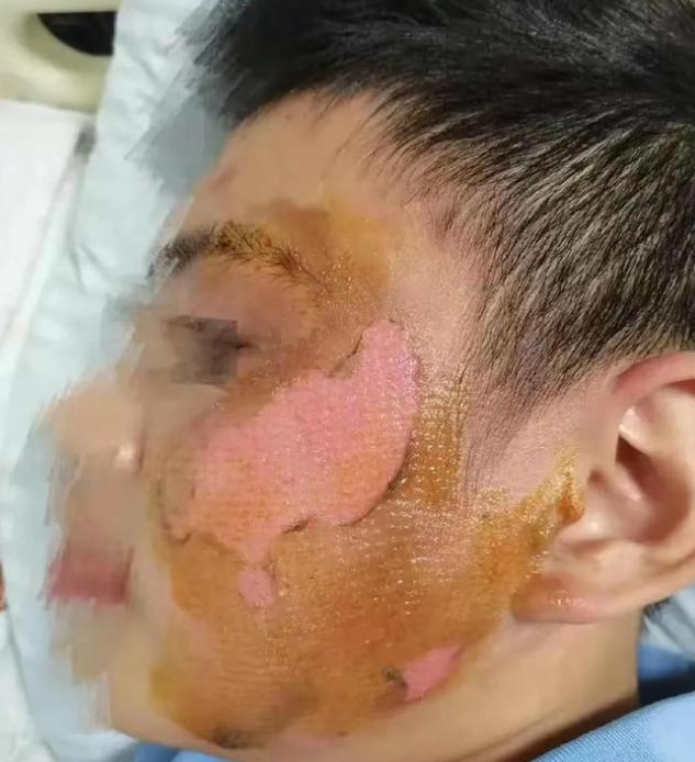 初二女生开水泼男同学脸炫耀：又不能把我怎么样，女生家长：她有抑郁症