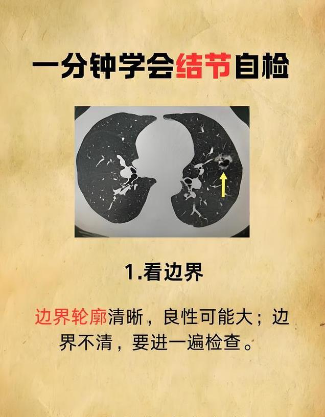 体检报告里的“结节”到底要不要切？科学解读来了