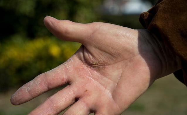 出汗不对劲竟藏大秘密？医生揭秘：5种汗液信号指向糖尿病