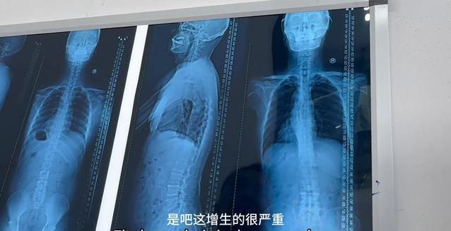 60岁大爷腰痛求正骨，医生看片吓一跳，脖子竟藏大问题