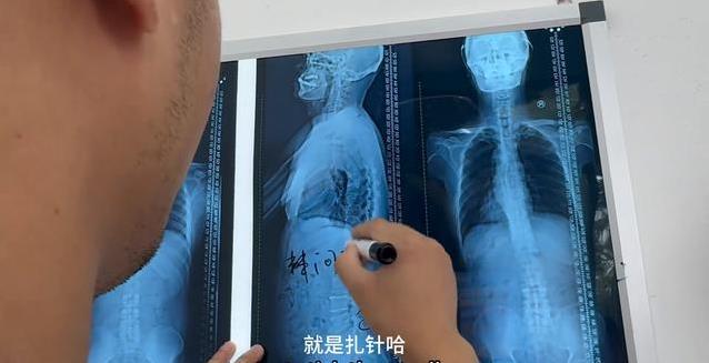 60岁大爷腰痛求正骨，医生看片吓一跳，脖子竟藏大问题