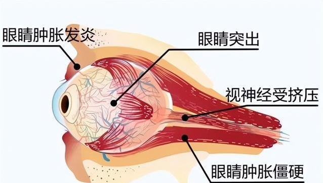 眼白发黄藏大病？5种异常信号，千万别不当回事！