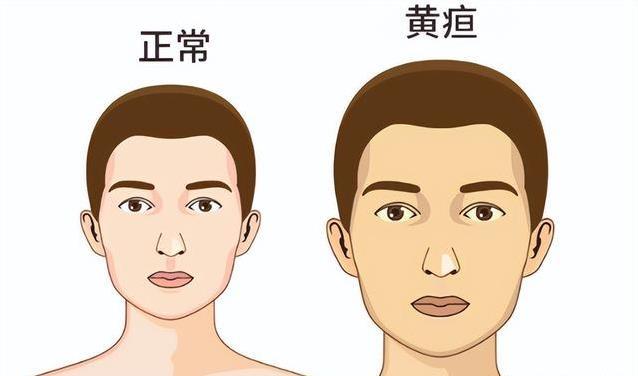 眼白发黄藏大病？5种异常信号，千万别不当回事！
