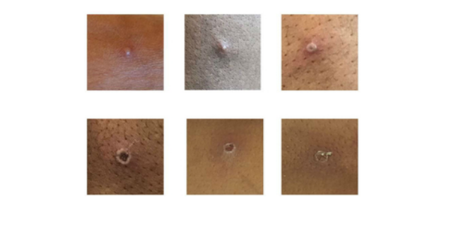 图为猴痘患者皮肤表面出现的症状（图：英国卫生安全局）