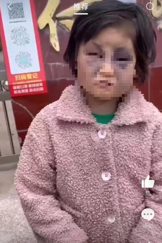 官方通报女童被母亲打成“熊猫眼”：沈某风精神残疾，已送养老中心