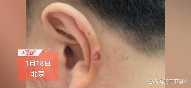 男子理发时耳朵被剪掉一块肉 理发店表示只赔200元