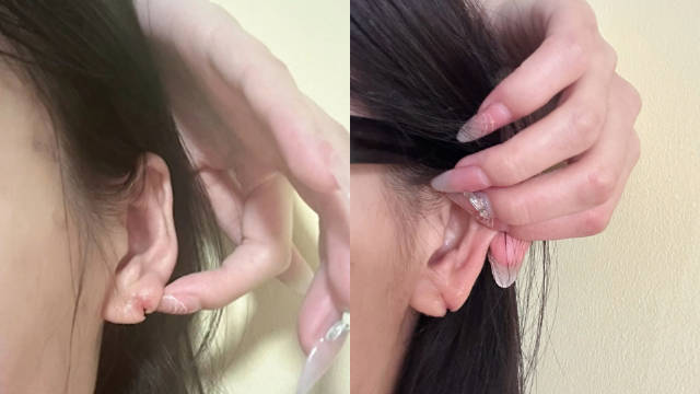 睡觉未摘耳饰致耳垂裂开