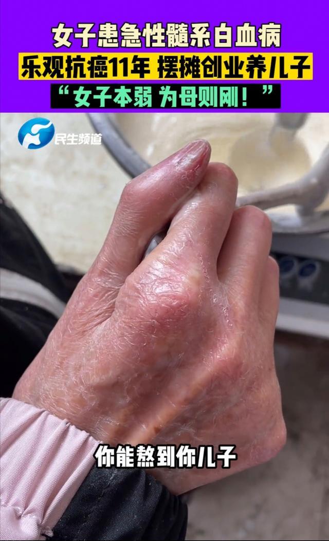 女子患急性髓系白血病 乐观抗癌摆摊11年养儿子