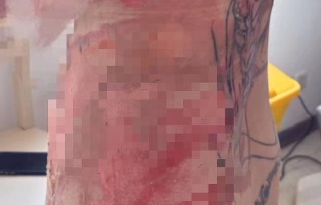 上海一女子拔火罐被烫伤