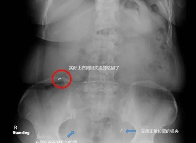 女子车祸后就医体内发现金属异物，竟是20年前结扎夹