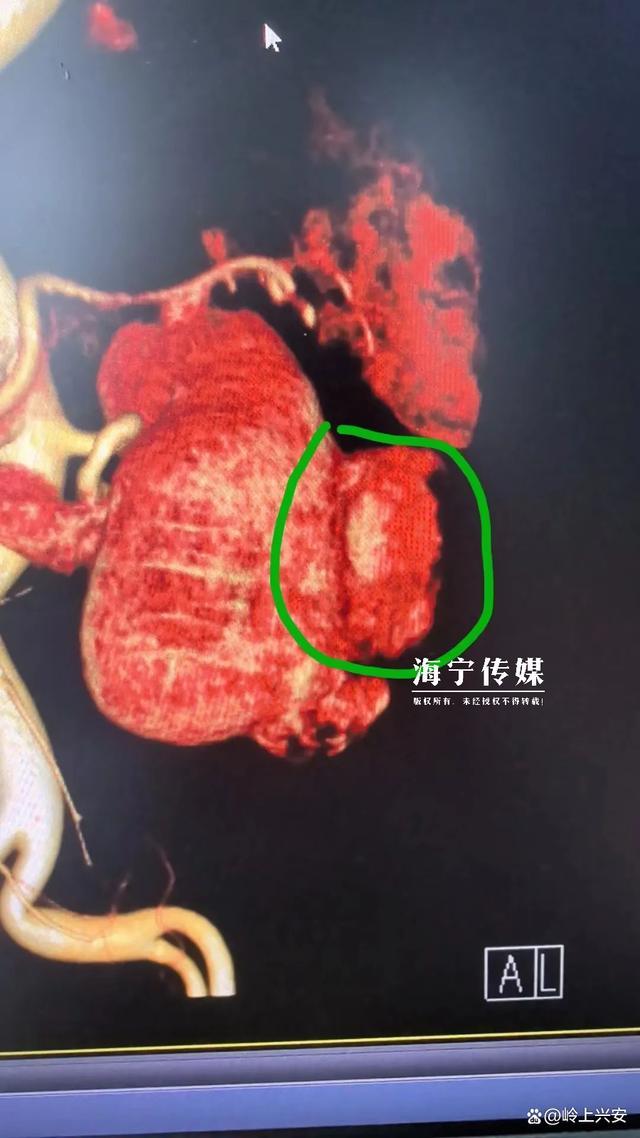 警惕：无任何症状！浙江一女子摔伤后做检查被查出肾癌