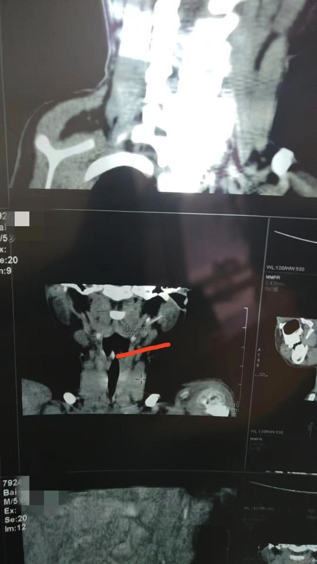 一科室10年12次留置针软管遗留