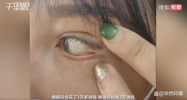 女子称花3万整容 眼球眼角被缝一起