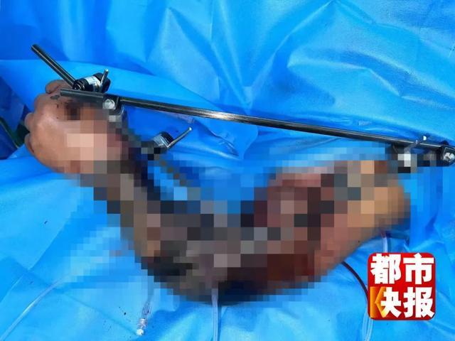 男子干农活手臂卷入机器 12小时手术奇迹保住胳膊