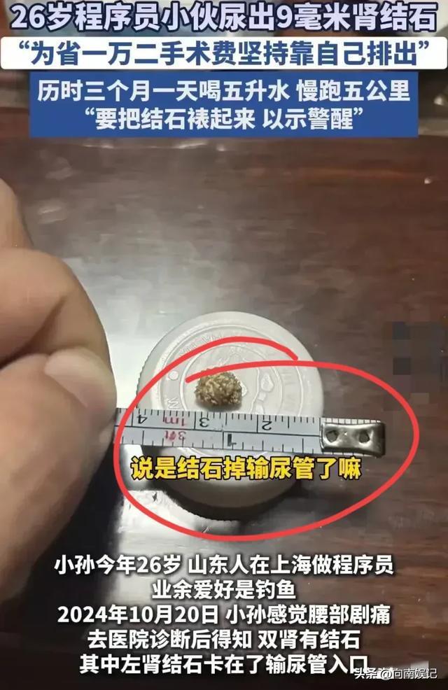 26歲程序員為省錢(qián)尿出9毫米腎結(jié)石 喝水與堅(jiān)持的力量