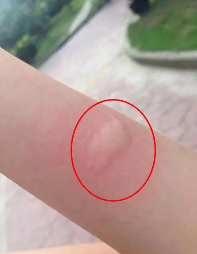 O型血的人更容易被蚊子咬嗎,？