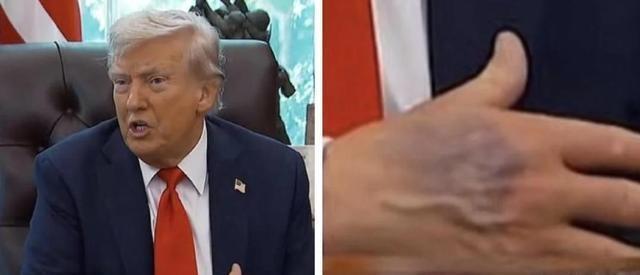特朗普身体真的“亮红灯”了吗 瘀斑与浮肿引发担忧