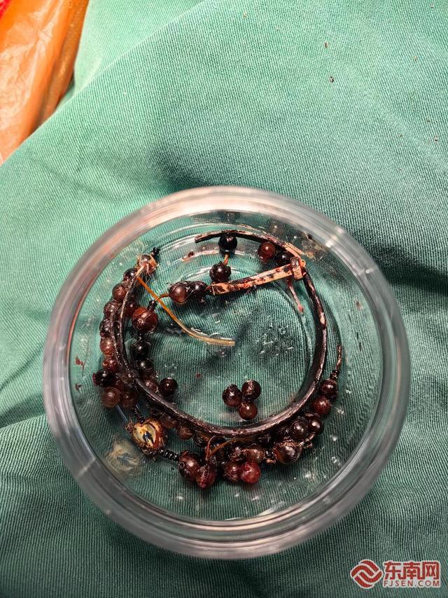 女子戴手镯十年没摘嵌进肉里 医生精细手术成功取出