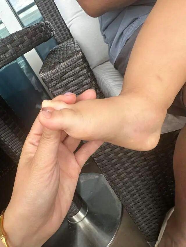 1岁孩子住美高梅酒店被毒虫咬伤 酒店态度强硬引发争议