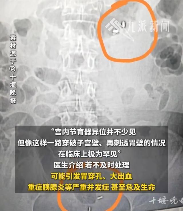 46岁女子腹痛3天就医 因10余年前的节育器异位