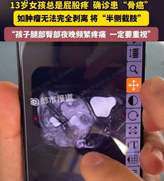13岁女孩频繁屁股疼确诊骨癌 未及时重视险酿大祸