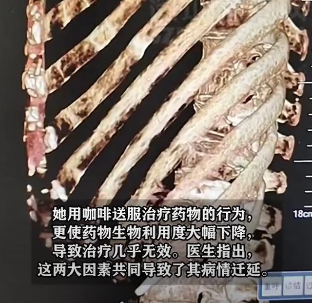 女子吃药用咖啡送服致药效减约60%