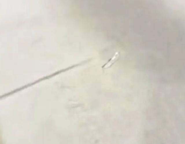 男子稱在海底撈疑吞下玻璃碎片至今未取 身體與精神雙重折磨