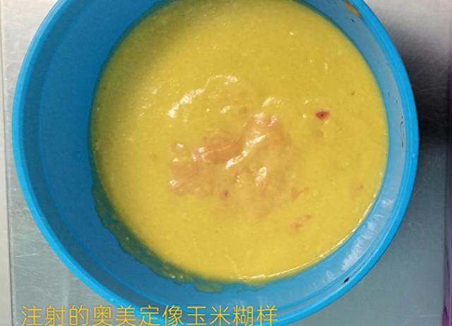 女子20年前注射隆胸 取出“玉米糊”