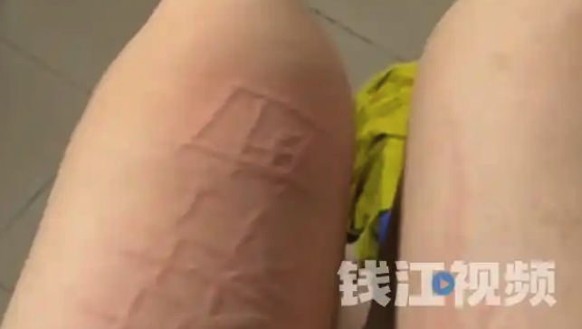 女子得了荨麻疹在皮肤上划字 医生回应：目前暂无治愈的手段