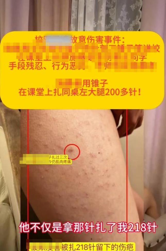 女生被同桌扎218针