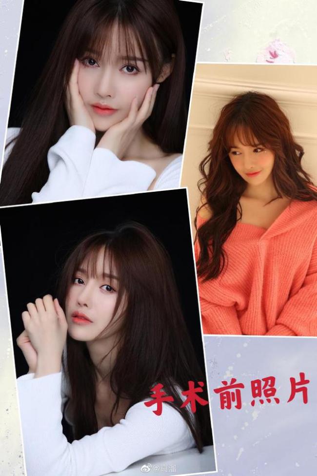 女演员高溜整容失败鼻尖坏死 院方：在走司法程序