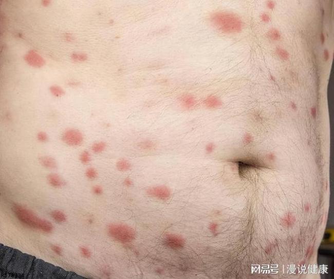 出现哪些症状 说明可能感染HPV病毒呢？