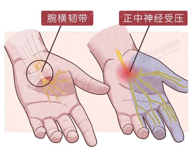 手指预测疾病？手麻可能是6种大病征兆