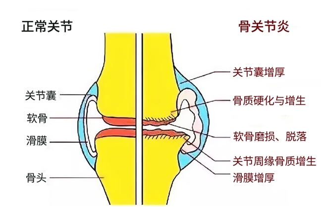 骨关节炎如何用药？盐酸和硫酸氨基葡萄糖胶囊谁更值得选？