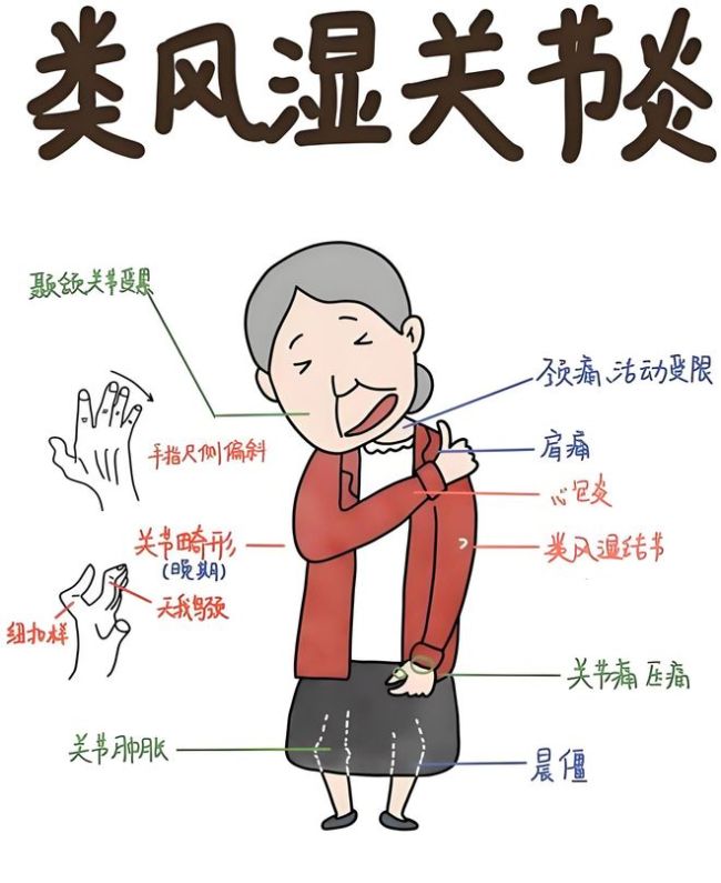 手指肿、膝盖痛？自查表来了！超过3条，及时就医！