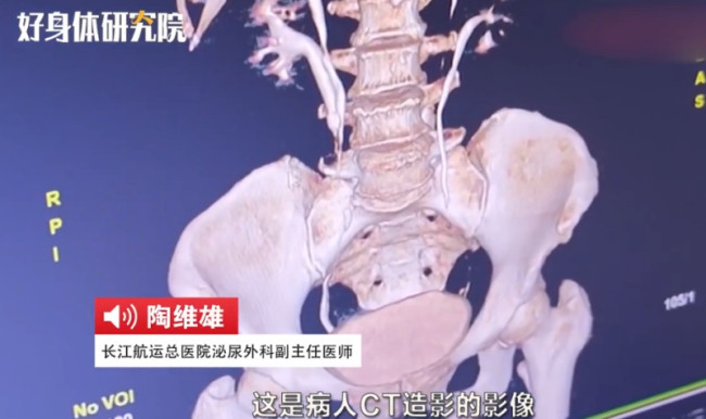 女子天生4个肾竟全部长结石，还有4条输尿管！