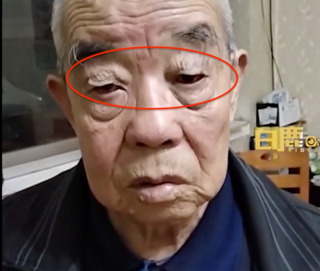 奶奶用胶带帮老伴提拉下垂眼皮