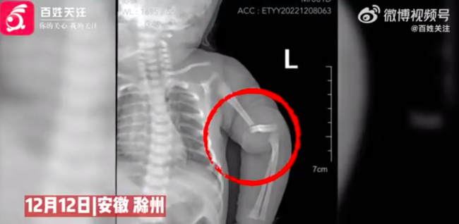 卫健委回应护士操作不当致婴儿骨折