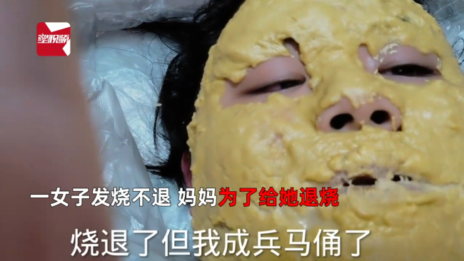 妈妈给女儿脸上“摊大饼”退烧 网友：没加葱花效果肯定打折