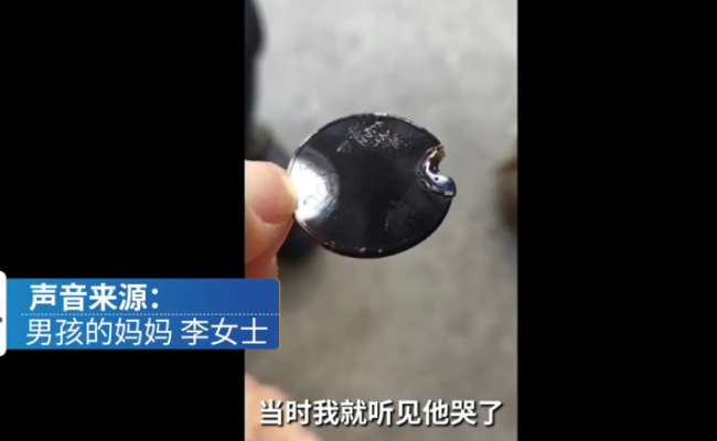 2岁男孩把硬币塞充电口手被炸黑