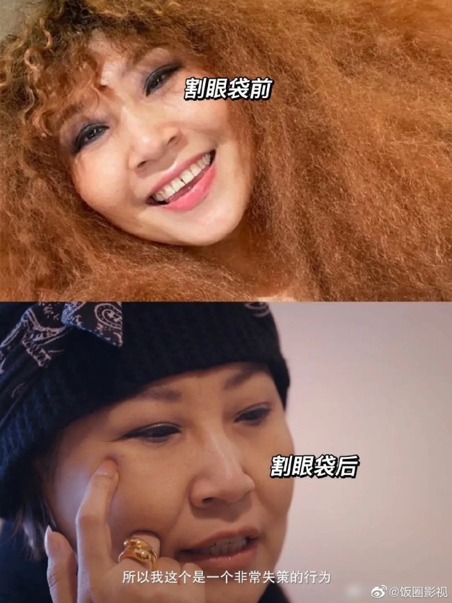 张蔷割眼袋失败喊话整容医生