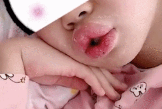 8岁女孩吃布洛芬过敏肿成香肠嘴，爸爸：烧也没怎么退