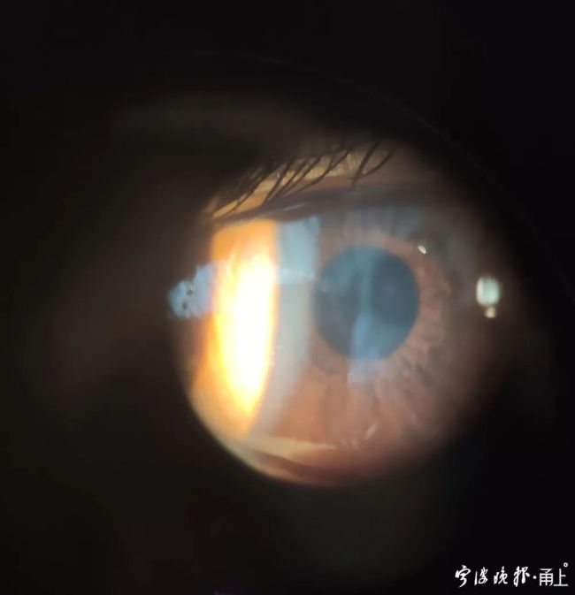 阳了后警惕病毒性结膜炎 一旦眼睛出现这些症状尽快就医