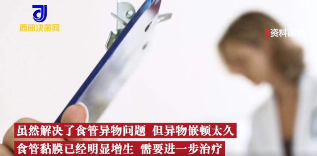 2岁娃咳嗽50天查出硬币卡喉