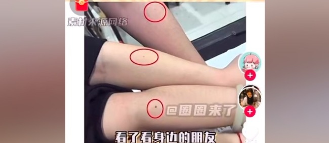 网友集体晒出左臂的痣