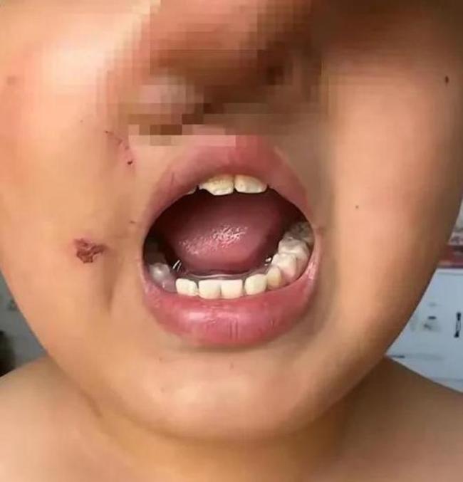 警方介入男童被虐待事件：12天暴力虐待被针扎磕掉牙等