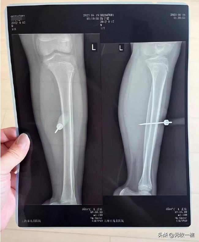 丧心病狂！男孩被同学用铁锥扎小腿 整根几乎没入腿部需全麻取出