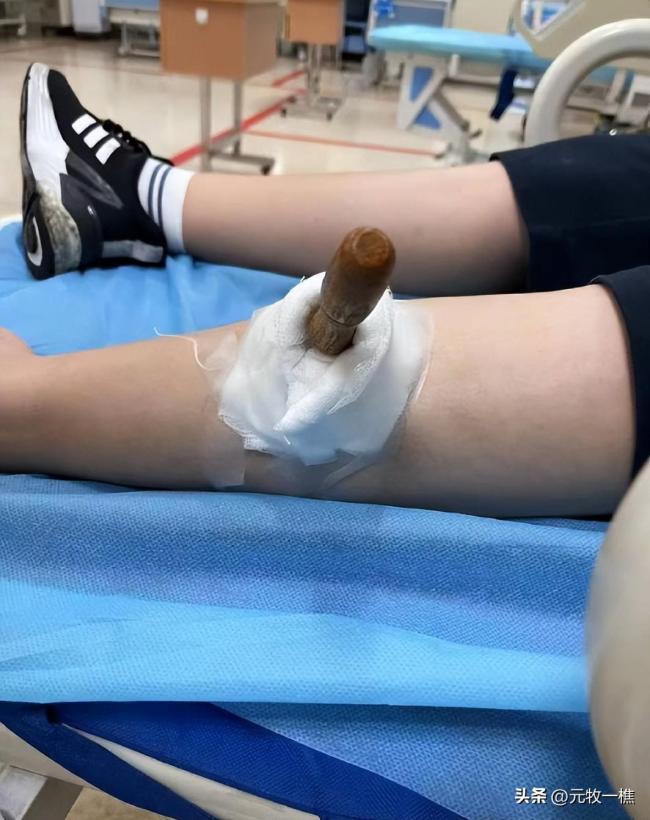 丧心病狂！男孩被同学用铁锥扎小腿 整根几乎没入腿部需全麻取出