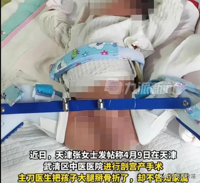 剖宫产后婴儿大腿被医生掰骨折？院方回应：涉事医生已停职 愿赔偿10万元