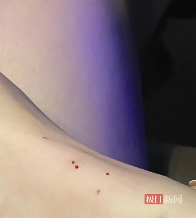 女子停车场被毒蛇咬伤,物业:正在排查它的来源